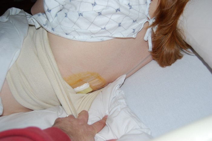 Epidural anyone?  