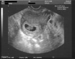 Ultrasound - 8 weeks.  Our little one has grown to 15.4mm!  You can see the head on the right, two arms in the middle and the butt on the left.  Our little spaceman!